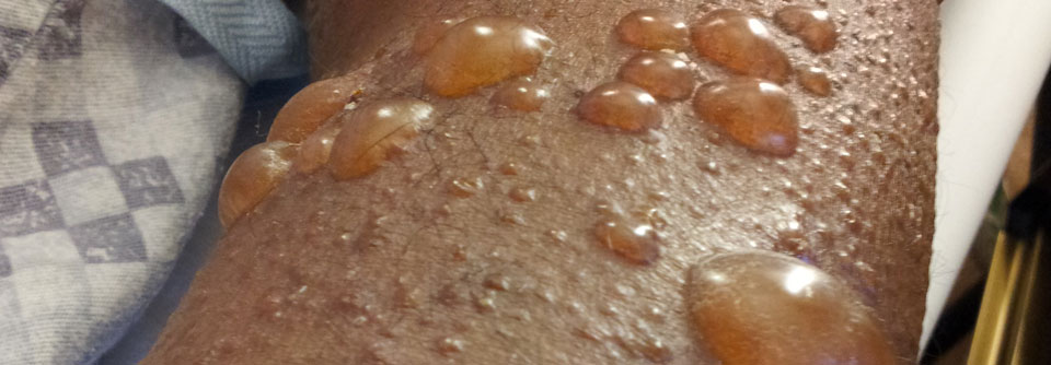 Bullöses Pemphigoid: Kohortenstudie weist erhöhtes Thromboembolierisiko auf Ärzt:innen sollten bei Pemphigoid-Patient:innen das erhöhte Thromboembolie-Risiko im Blick behalten.