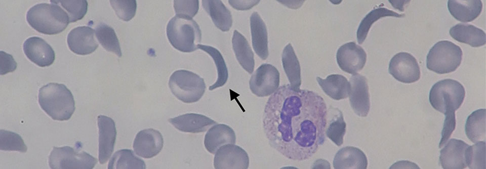 In diesem Ausstrich sind die Sichelzellen als Folge der Polymerisierung des Hämoglobins S auf den ersten Blick zu erkennen.