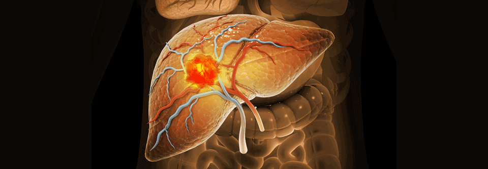 Die Kombination aus CPI und TKI in der HCC-Erstlinie scheint zwar das Überleben zu verbessern, die Behandlung bringt jedoch eine hohe Nebenwirkungsrate mit sich.