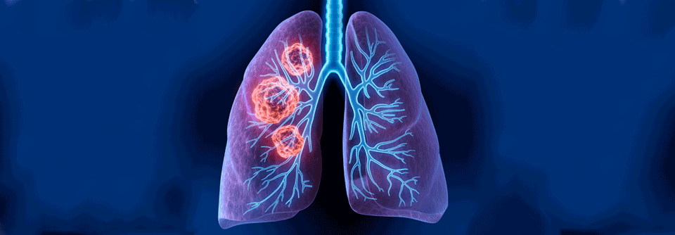 Um zu prüfen, ob gebrechliche NSCLC Patient:innen operiert oder bestrahlt werden sollten, wurden VATS, RATS und SBRT miteinander verglichen.