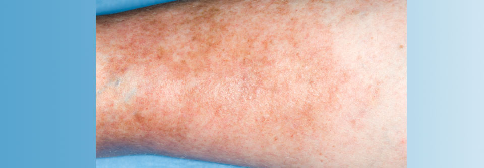 Betroffene stufen solche Hautveränderungen mitunter als normale Alterungserscheinung ein.