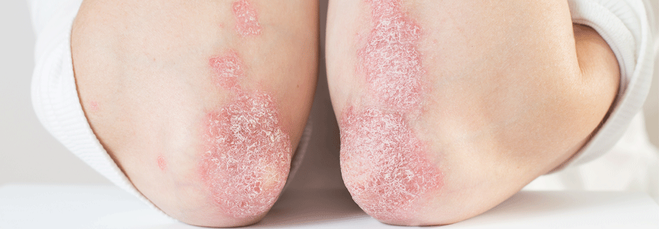 Therapie bei Psoriasis: Neue Evidenz kommt aktuell aus einer belgischen Pso-Kohorte.