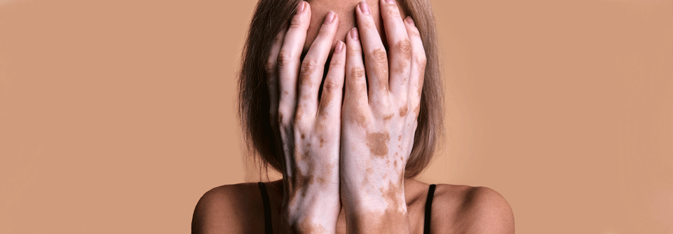 Vitiligo-Patienten leiden oft am meisten unter den betroffenen Stellen im Gesicht.