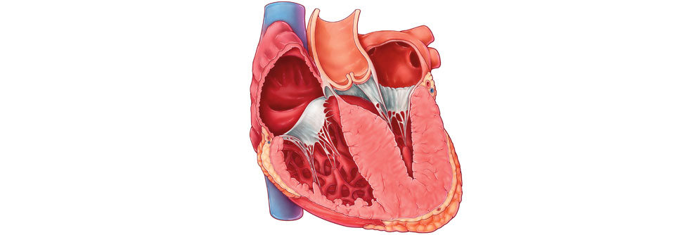 Hyperkontraktile Kardiomyozyten führen letztlich zur Ventrikelhypertrophie.