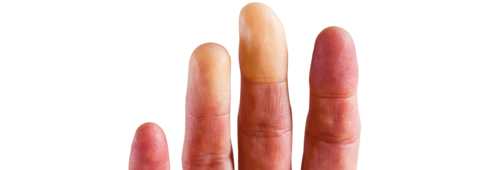 Eine gestörte Mikrozirkulation in den Fingern kann zu abnormen Blutzuckerwerten führen.