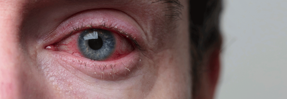 Akute hämorrhagische Konjunktivitis droht vor allem in Urlaubsregionen Die "Apollo-11-Krankheit" kann ein ungewolltes Souvenir einer Fernreise sein.