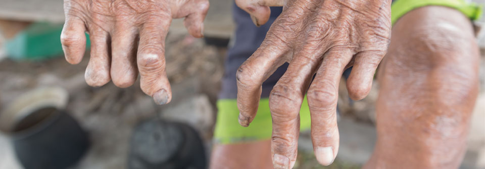 Bei Leprapatienten wird durch die Neuropathie häufig der Nervus ulnaris geschädigt. In der Folge bildet sich die typische Krallenhand.