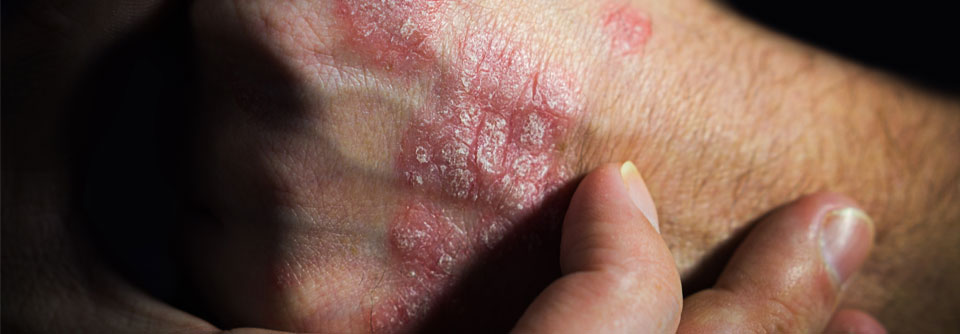 Deucravacitinib wurde zur Behandlung der Plaque­psoriasis zugelassen.