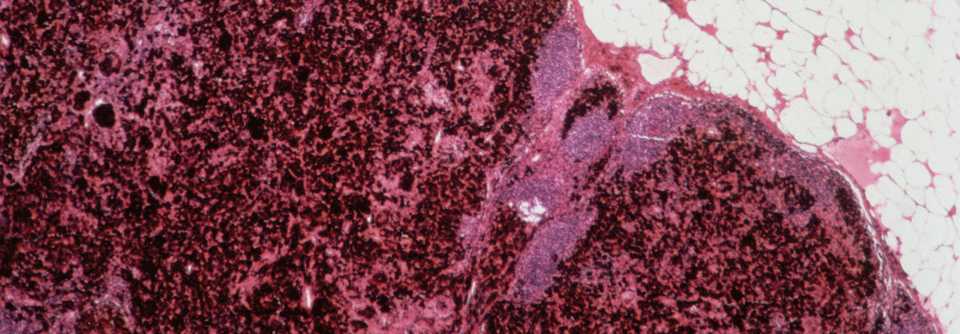 Bei der Hämochromatose wird exzessiv Eisen m Gewebe gespeichert. Ein erhöhter Ferritinspiegel sollte den Verdacht auf die Erkrankung lenken. 