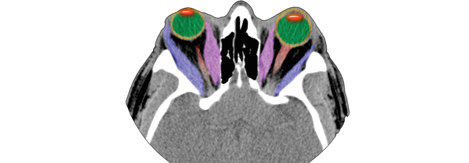 Vermehrte Produktion von Hyaluronsäure lässt bei Exophthalmus das Orbitagewebe anschwellen.