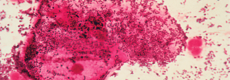 Bei dieser bakterieller Vaginose lassen sich im Zervixabstrich Epithelzellen (pink, Bildmitte) erkennen, die über und über mit Gardnerella vaginalis bedeckt sind.