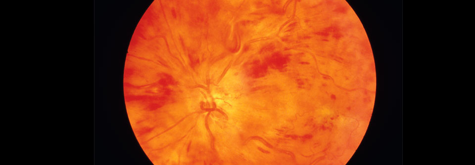 Rupturierter Zentralvenenverschluss mit Einblutungen in die Retina.