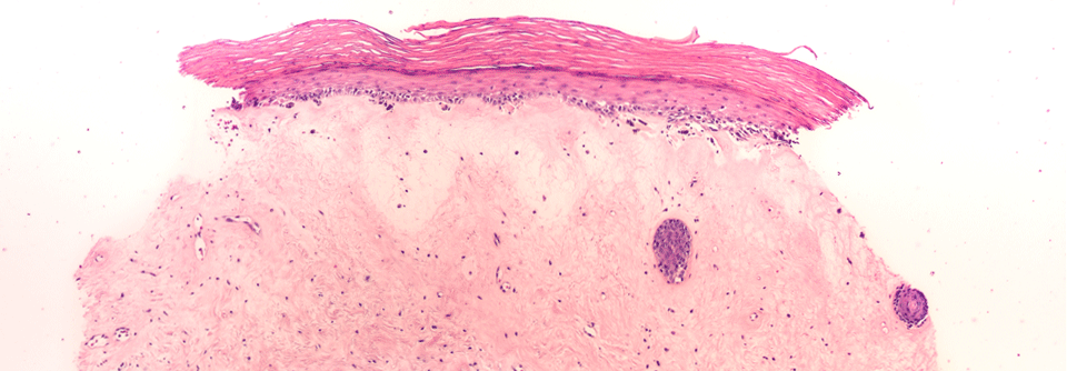 Der Lichen sclerosus geht mit  Juckreiz, Schmerzen und Dyspareunie einher.