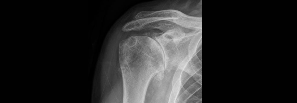 Um Zufallsbefunde zu vermeiden, sollte man nur röntgen, wenn eine Arthrose im Akromioklavikular- oder Schultergelenk als Schmerzursache vermutet wird. In diesem Fall liegt eine Omarthrose vor.