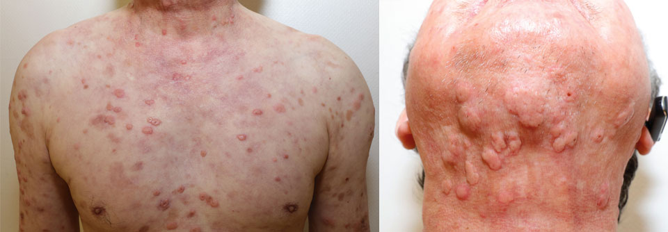 Kutane Manifestationen des VEXAS-Syndroms bei einem 66-Jährigen: An Oberkörper, Hals und den Streckseiten der Arme finden sich multiple, disseminierte, druckdolente und urtikarielle Papeln und infiltriert wirkende Plaques.
