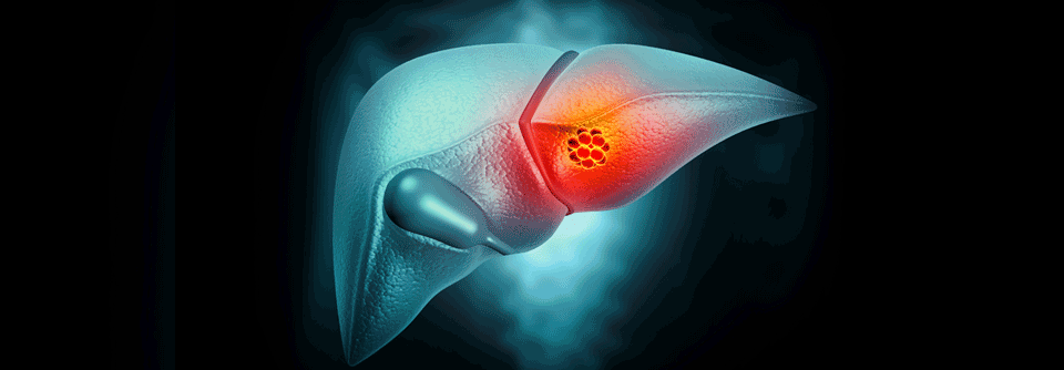 Die Abhängigkeit der HCC-Zellen von Arginin-Konzentrationen im Zellinneren könnte einen therapeutischen Angriffspunkt liefern. 