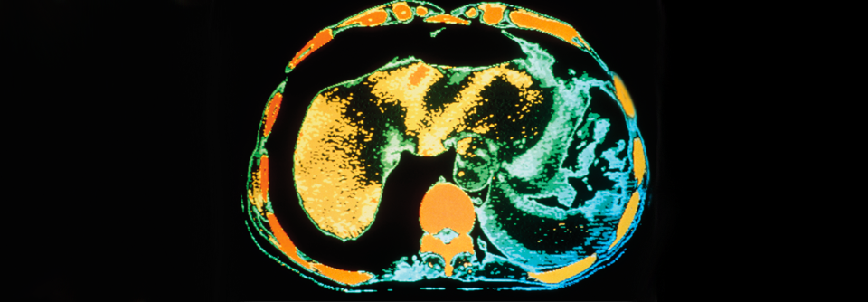 Die Milz erhält 5–10 % des Herzzeitvolumens. Die Ruptur des Organs (unten rechts, blau) kann zu heftigen Blutungen mit katastrophalen Folgen führen.