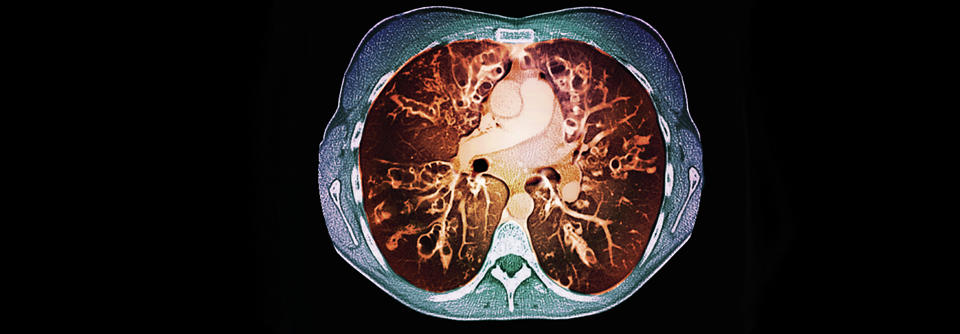Mukoviszidose bei den Genen packen Auf dem Thorax-Scan sieht man deutlich die abnorme Schleimproduktion (grau).