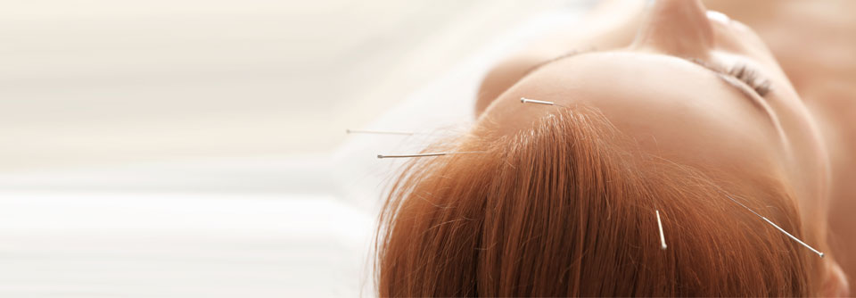 Der IGeL-Monitor hat die Behandlungsmethode der Akupunktur bei Spannungskopfschmerz als „tendenziell positiv“ bewertet.