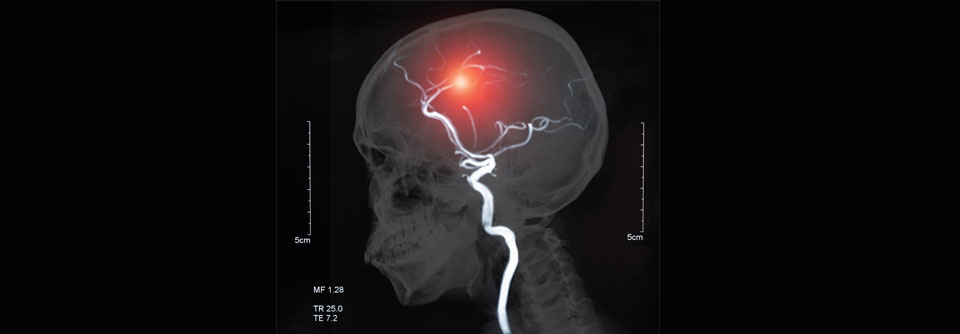 Die hämorrhagische Transformation des Infarktgebiets kann den Reperfusionserfolg beeinträchtigen.