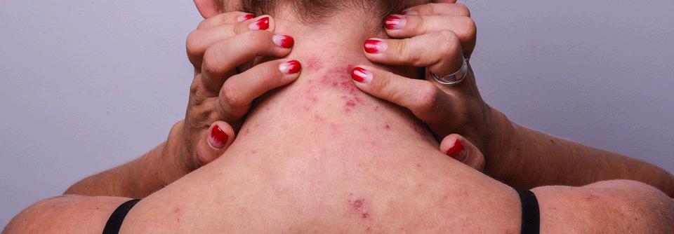 Die Th2-Mediatoren, allen voran IL-13, bringen bei einer atopischen Dermatitis das Immunsystem an spezifischen Punkten aus der Balance. 