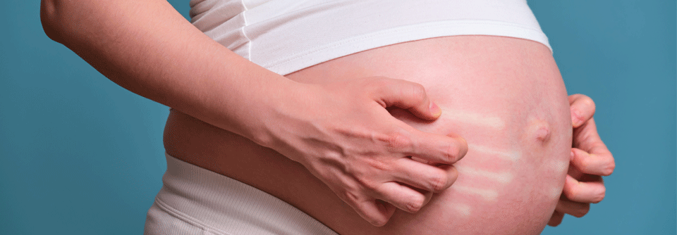 Es gibt zwei Dermatosen, die man bei Schwangeren hauptsächlich antrifft: die atopische und die polymorphe Schwangerschaftsdermatose.