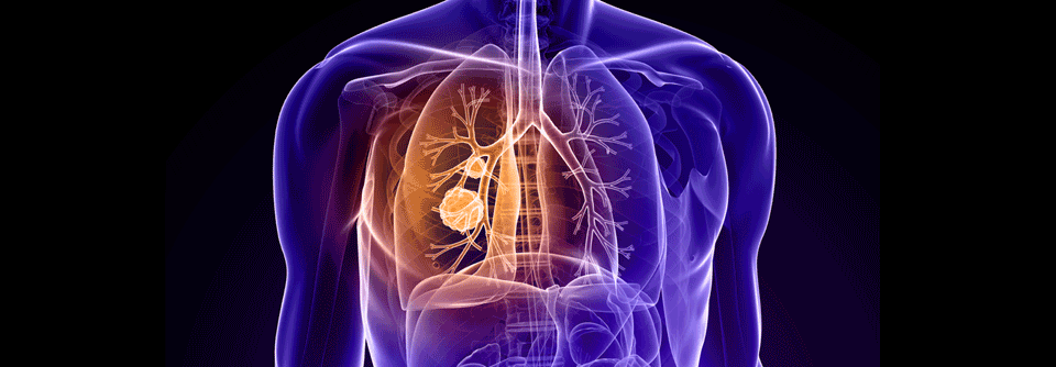 Ein neues Antikörper-Wirkstoff-Konjugat kann das Überleben von NSCLC-Patient:innen verbessern.