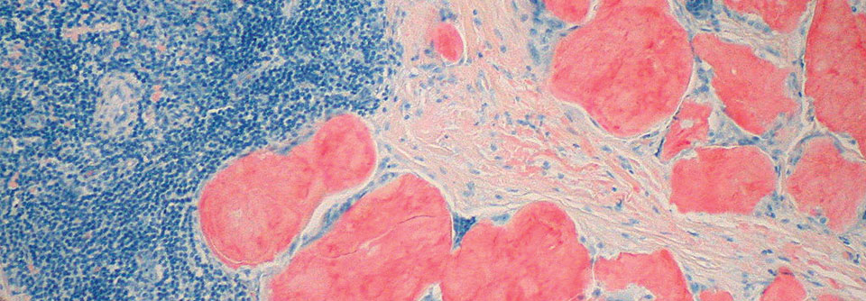 Neue Therapie bei AL-Amyloidose auch für ältere Patienten geeignet Amyloidablagerungen lassen sich in den Geweben besonders gut mit einer Kongorotfärbung nachweisen.