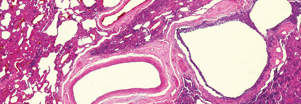 Fibrosierendes Lungengewebe z.B. im Rahmen einer ILD kann der pulmonalen Hypertonie den Boden bereiten.