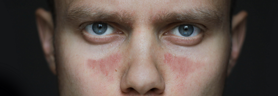 Effektiv Organschäden bei SLE verhindern Systemischer Lupus erythematodes ist eine chronische und komplexe Krankheit mit einer Vielzahl von klinischen Manifestationen.