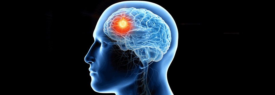 Hirnmetastasen treten immer häufiger auf.