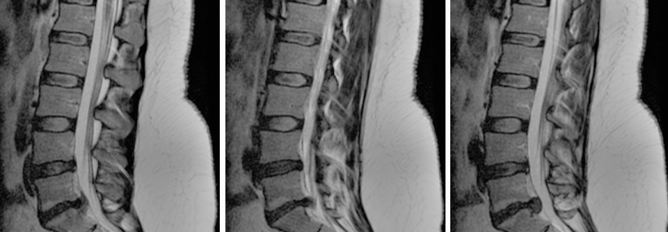 Bandscheibenprotrusion (L4/L5) und Bandscheibenvorfall (L5/S1) bei einer 29-Jährigen mit Kaudasyndrom.
