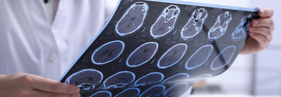 Im Bereich der MS-Forschung präsentierte Merck Erkenntnisse zur ‚schwelenden MS‘ und gab einen Ausblick auf Bruton-Tyrosinkinase (BTK) als potenziellen therapeutischen Signalweg.