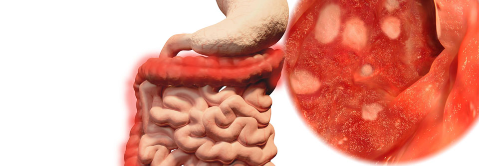 Tofacitinib könnte bei der Colitis ulcerosa als Alternative zu Prednisolon eingesetzt werden.