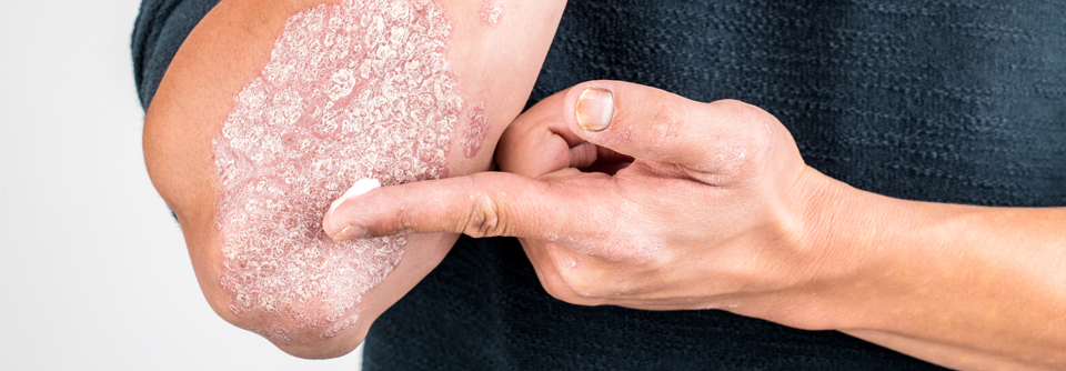 Eine auf PAD-Technologie™ basierte Creme könnte die Behandlungsergebnisse bei Psoriasis verbessern.