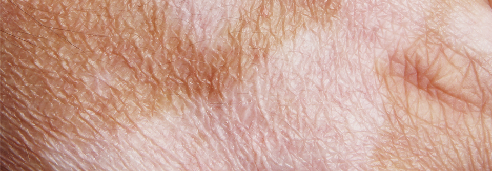 Vitiligo ist eine bisher sehr selten beobachtete Nebenwirkung des Interleukin-4/13-Hemmers Dupilumab.