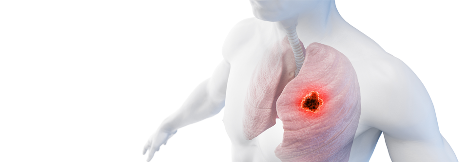 Beim fortgeschrittenem NSCLC auf eine zielgerichtete Tumortherapie setzen Molekularpathologische Untersuchungen helfen spezifische Resistenzmechanismen zu detektieren, um die Behandlung gegebenenfalls daran anpassen zu können.