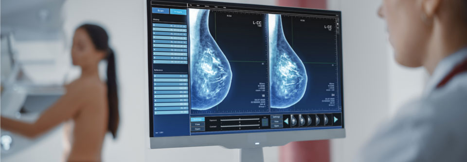 Datopotamab-Deruxtecan scheint die PFS von HR+/HER2- Brustkrebs-Patient:innen zu verbessern.