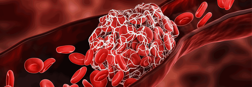 Venöse Thromboembolien verschlechtern bei Krebspatienten die Prognose deutlich.