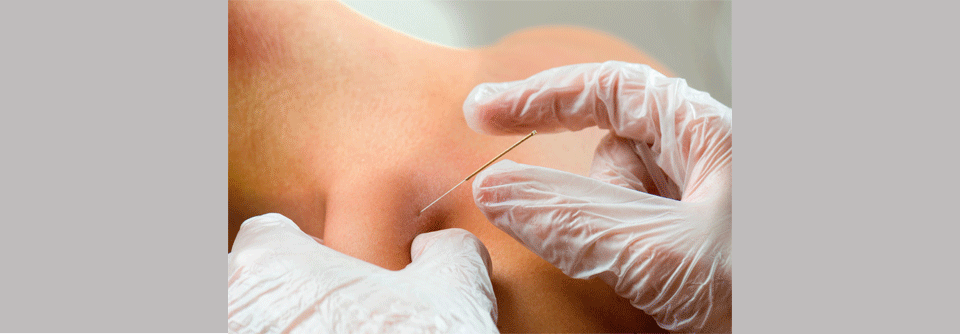 Beim Dry Needling wird mit 10 bis 65 mm tiefer eingestochen als bei der klassischen Akupunktur. (Agenturfoto)