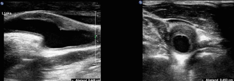 Longitudinale (links) und transversale (rechts) Einstellung einer nicht-stenosierenden Plaque. Die jeweils größte messbare Dicke gilt als Maß für die Verlaufskontrollen.