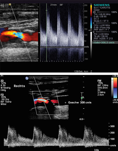 Diese Stenose der A. carotis interna (mit zwei unterschiedlichen Ultraschallsystemen gemessen) blieb über 15 Jahre unverändert bei 70 %.