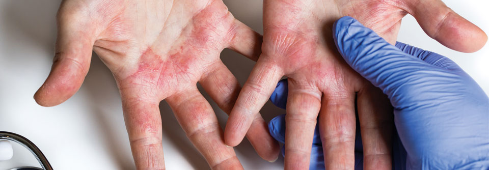 Die Handflächen sind Triggern der atopischen Dermatitis besonders stark ausgesetzt.