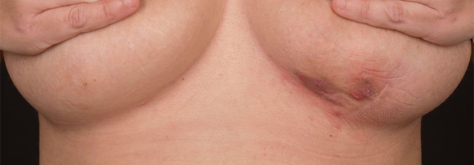 Versorungslücken bei Hidradenitis suppurativa schließen Neben den Axillen, der Perianalregion und den Leisten gehört der submammäre Bereich zu den klassischen Lokalisationen der Acne inversa.