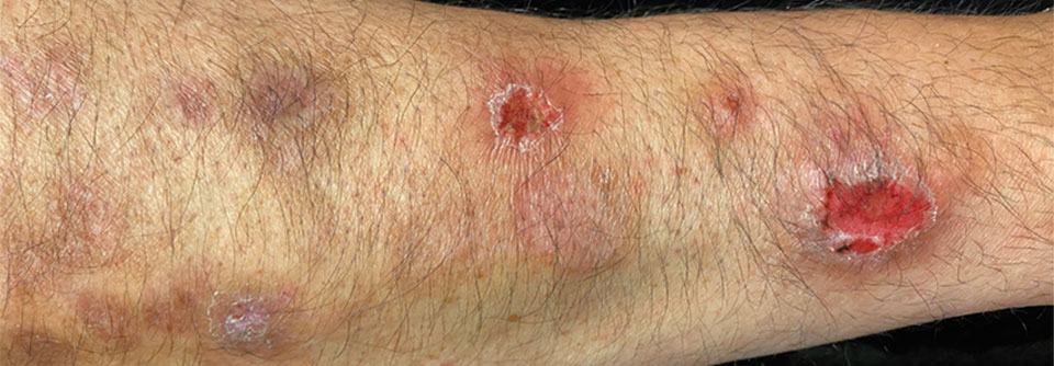 Beim Skin-Picking-Syndrom nehmen die Patienten oft Pinzetten oder Nadeln zu Hilfe, um z.B. in der Haut herumzubohren.