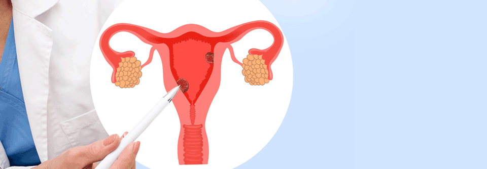 Eine Kombinationstherapie reduziert das Progressionsrisiko bei Patient:innen mit Endometriumkarzinom um 72 %.