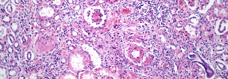 Eine Polyarteriitis nodosa kann auch andere Organe beeinträchtigen, beispielsweise die Nieren. 