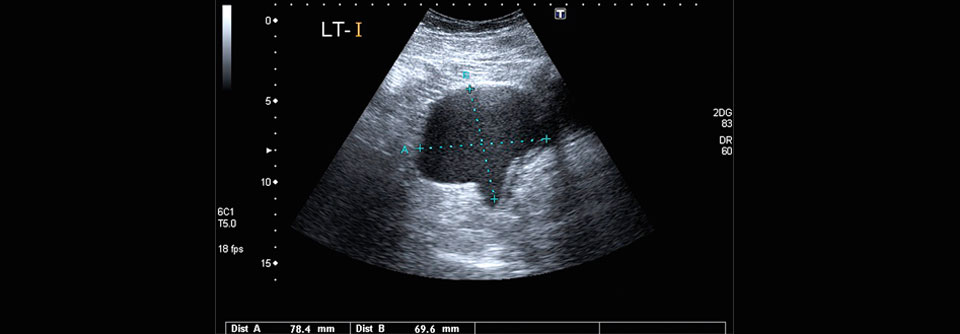 Endometriosezysten, wie hier im Ovar, können starke Schmerzen verursachen.