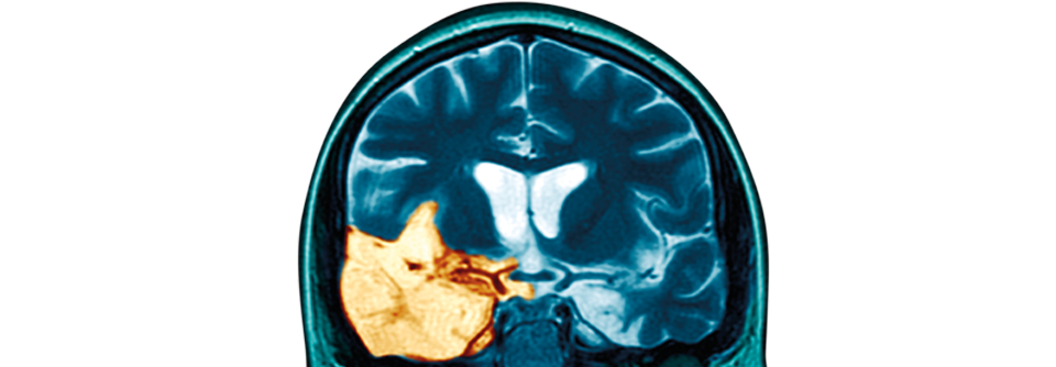 Enzephalitis im rechten Temporallappen, hervorgerufen durch eine Herpes-simplex-Infektion.