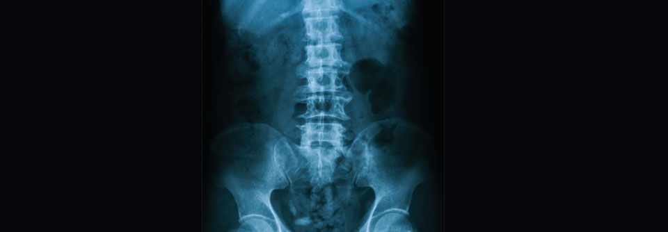 Die Sakroiliitis im Röntgenbild gehört zu den wegweisenden Parametern bei der axSpA-Diagnose.
